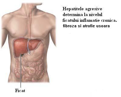 hepatita