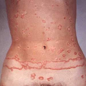 Psoriazis Dr Rares Simu