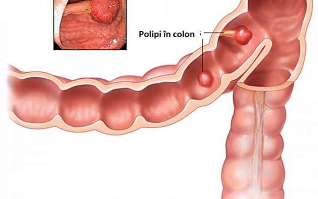 COLON CANCER